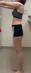 RF＋Eダイエットbefore